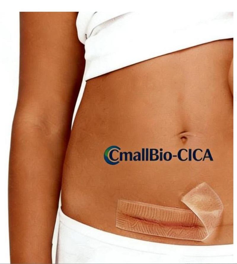 C-Section Hypertrophic Scars کے لیے کون سا اسکار پیچ بہترین ہے؟ ایک 2026 میڈیکل گریڈ اسکار پیچ خریدنا گائیڈ